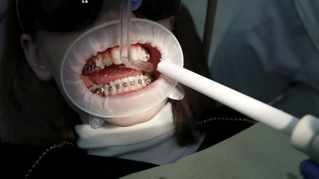 Close-up of a patient with a mouth dilator in a dental chair, braces on his teeth, the doctor performs various procedures with the help of dental instruments.