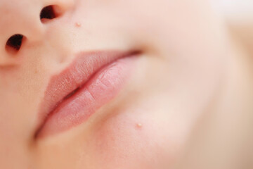 Obraz premium Teenage acne on the chin. Close up face with pimple. Teen problem. High quality photo.