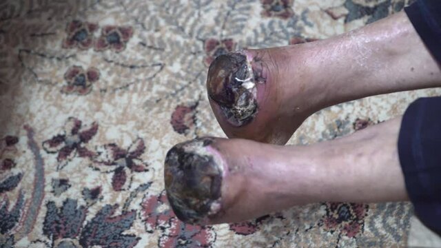 Sepsis wound or gangrene at foot of uncontrolled diabetic patient cause of amputation toe or legs.