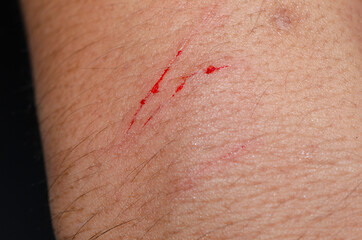 Injuries from falling in the garden. A man showing a lesion on his arm. Arm is wound from a knife....