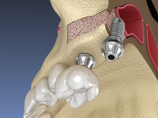 Sinus Lift Surgery - implant installation. 3D illustration © Alex Mit