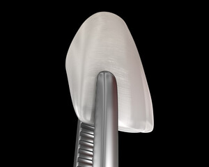 Veneer installation procedure over central incisor. Medically accurate tooth 3D illustration