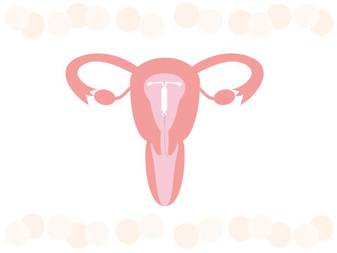 避妊アイテム（ミレーナ）