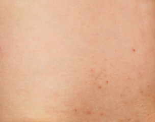 Redness, damage and irritation on white skin from waxing