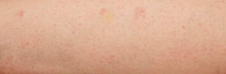 Redness, damage and irritation on white skin from waxing