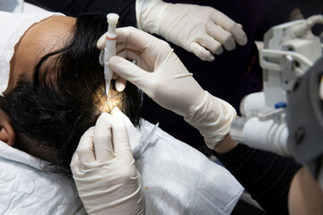 Hair transplantation process, pulling hair follicles back and replanting them. Riyadh Saudi Arabia...