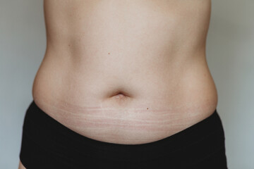 Fototapeta na wymiar womans belly with stretch marks 