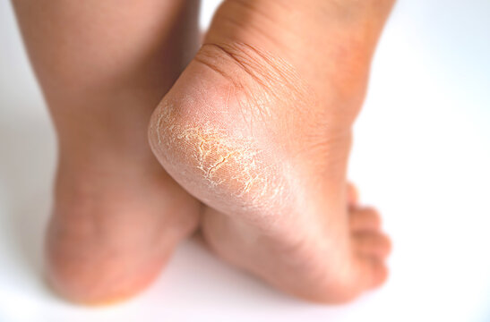 Close Up Deep Crack Dry Heel  Of Woman Foot With Bad Skin Is Covered With Cracks