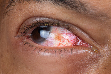 Red eye of african man with conjunctivitis due to pollen allergy, details of redness of the...