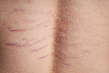 Close up view of the back with striae distensae (striae rubrae) on the skin. The concept of impaired skin elasticity during puberty