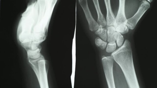 Doctor pointing at hand and wrist x-ray or CT scan image