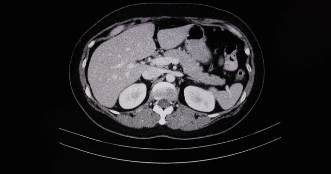 A motion CT scan of an abdomen of a patient with umbilical hernia.