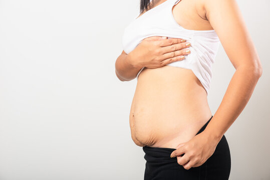 Close Up Of Asian Mother Woman Showing Stretch Mark Loose Lower Abdomen Skin She Fat After Pregnancy Baby Birth, Studio Isolated On White Background, Healthy Belly Overweight Excess Body Concept