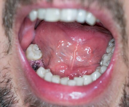 Nahaufnahme einer Zahnlücke in einem männlichen Mund für ein Zahnimplantat mit frischer offener Wunde und Blut, Deutschland
