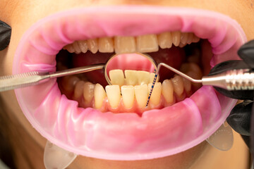 the dentist examines the depth of the patient's gums