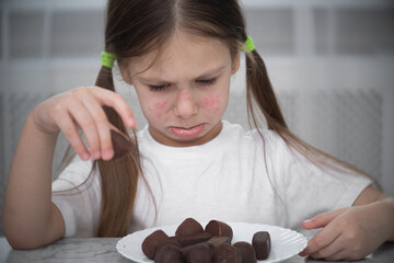 A little girl with an allergic rash on her cheeks sits at a table next to chocolates. allergy skin...