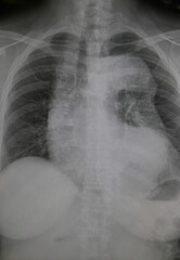 X-Ray Image Of Human Chest for a medical diagnosis.