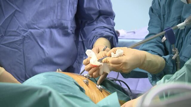 Surgeons perform laparoscopic abdominal surgery.