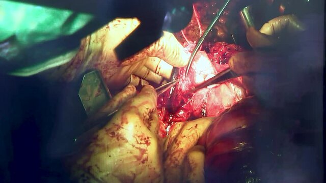 Doctors perform abdominal surgery. Shooting from monitor. Contains reflections.