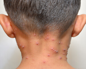 Obraz premium Chicken pox disease on the body of South East Asian boy.