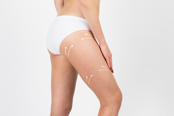Cellulite removal scheme. White arrows markings on legs young girl. Lifestyle and health concept.