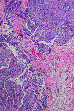human cancer cells of meibomian gland tissue tumour