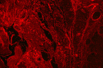 Fluorescence basal cell carcinoma of human