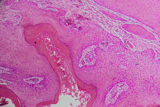 human cells, well differentiated squamous cell carcinomas