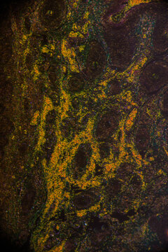 basal cell carcinoma of human