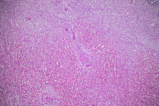 human spleen tissue infarction