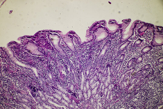 human stomach gastric mucosa intestinal metaplasia