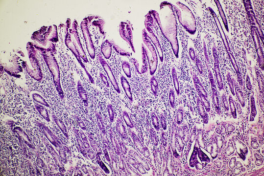 human stomach gastric mucosa intestinal metaplasia