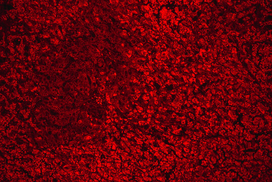 chronic obstruction of human liver