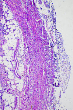 Suppurative inflammation of human appendix