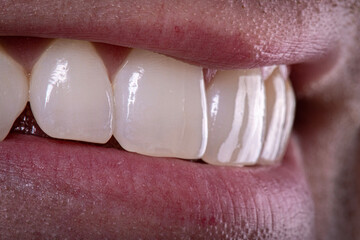 close up of lips and teeth