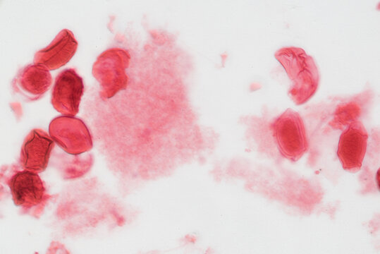 eggs of blood flukes, micrograph.