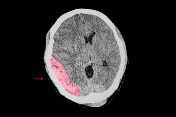 Traumatic brain injury patient with EDH