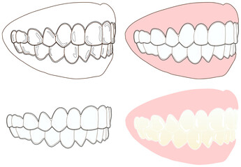 正しい歯並びに透明なマウスピースを付けた横向きセット