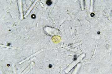 Artificial honey with large rectangular sugar crystals under microscope. Natural honey mixed with...