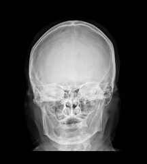 X-ray picture, skull