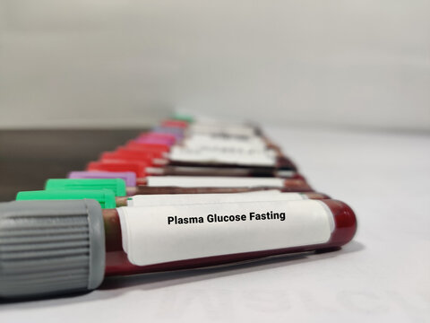 Blood samples for Plasma glucose Fasting (FGP) test. Fasting blood sugar(FBS) for diagnosis hyperglycemia or hypoglycemia in Diabetes Mellitus (DM). A medical testing concept.