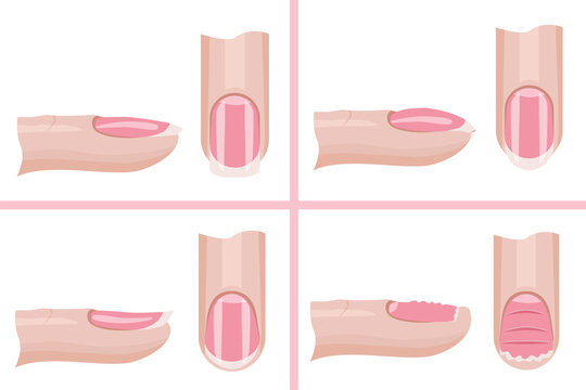 Nail care. Types of the nail plate. Illustration for the manicure guide. Hand nail care .Vector illustration