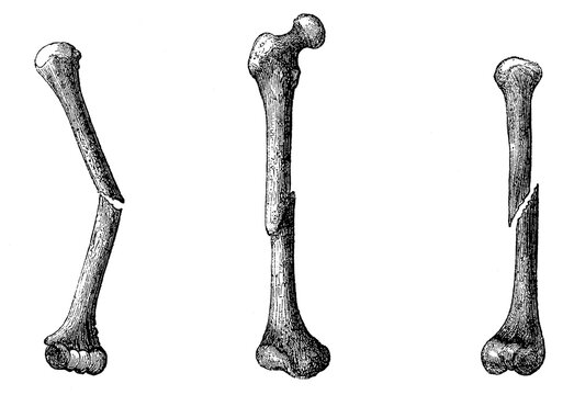 Fracture of the humerus without displacement, fracture of the femur with displacement, fracture of the humerus with displacement and rotation. Illustration of the 19th century. White background.