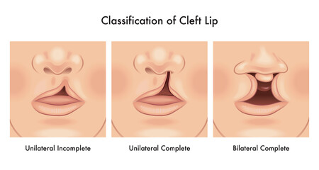 Medical illustration shows a classification of cleft lip, with annotations.