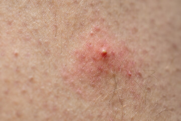White pimple on human skin in macro detail.