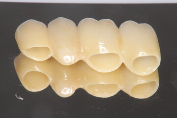 ジルコニア　セラミックブリッジ