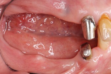 歯の喪失　歯科治療