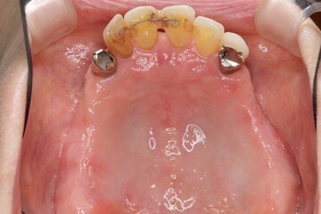 歯の喪失　入れ歯