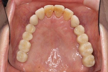 インプラント治療