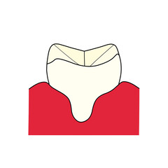 病気の歯茎と歯のイラスト